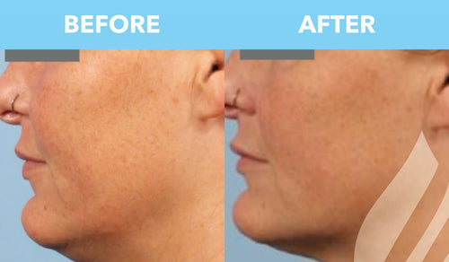 Matrix™: Redefining Your Skin with Customized Radiofrequency (RF) and RF Microneedling Treatments